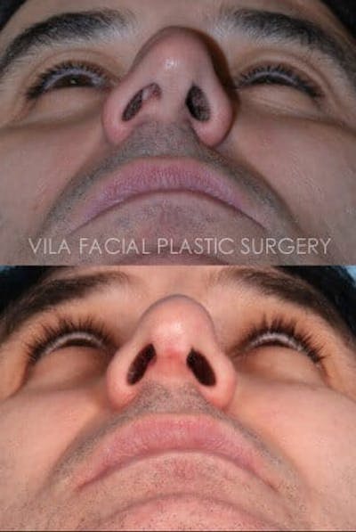 Rhinoplasty Before & After Gallery - Patient 20061762 - Image 1