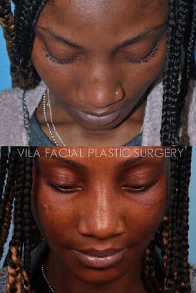 Rhinoplasty Before & After Gallery - Patient 20061763 - Image 1