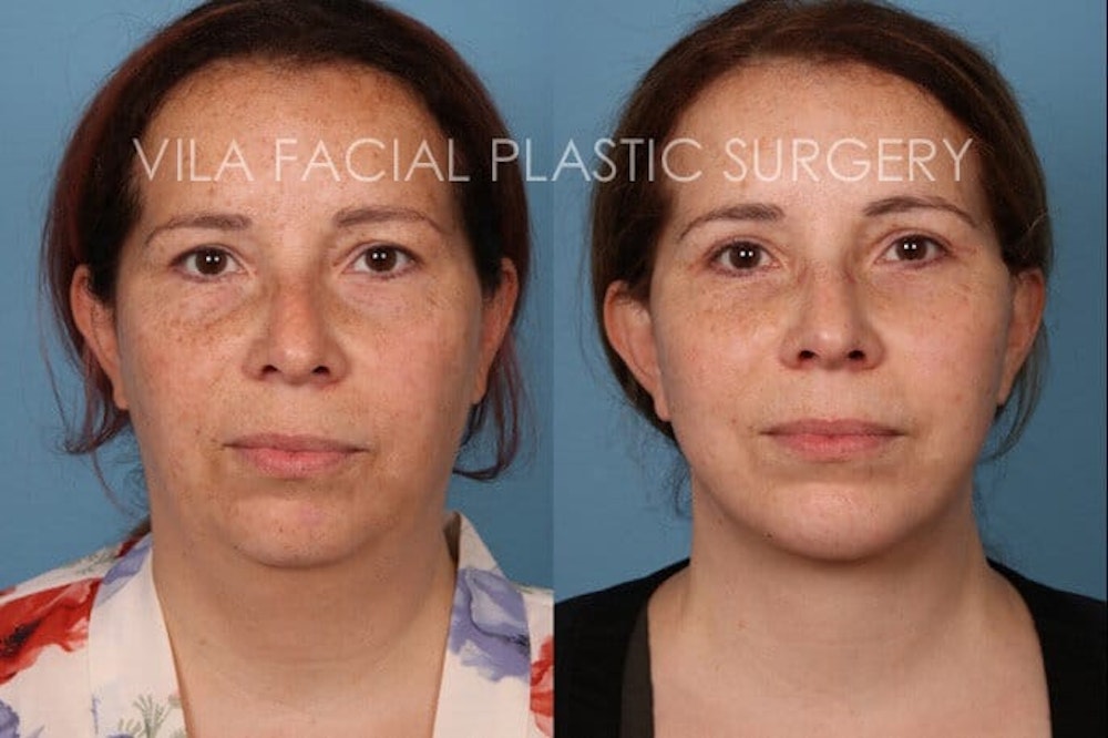 Facelift in Portland Before & After Photos