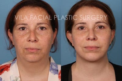 Facelift Before & After Gallery - Patient 20061771 - Image 1