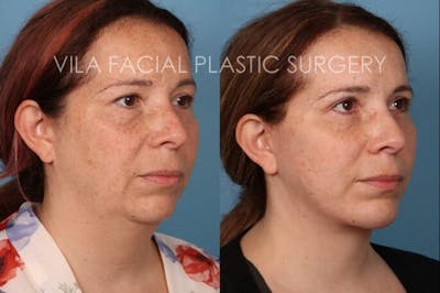 Facelift Before & After Gallery - Patient 20061771 - Image 2