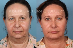 Facelift in Portland Before & After Photos