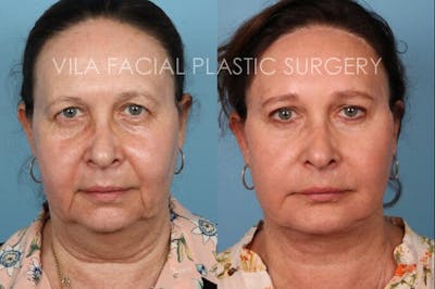 Facelift Before & After Gallery - Patient 20061772 - Image 1