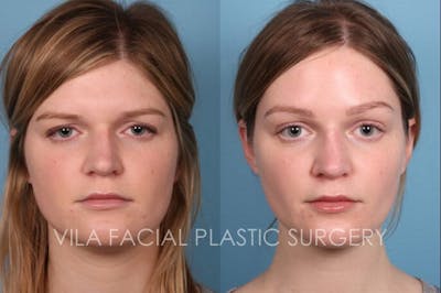 Browlift Before & After Gallery - Patient 20061777 - Image 1
