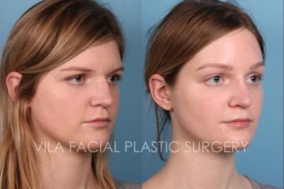 Browlift Before & After Gallery - Patient 20061777 - Image 2