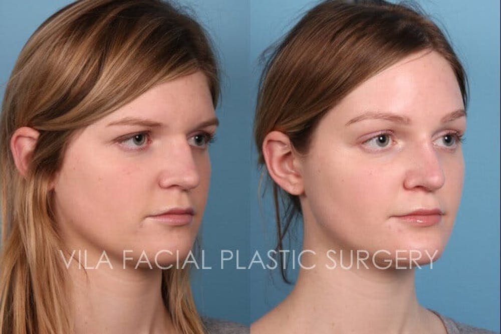 Browlift Before & After Gallery - Patient 20061777 - Image 2