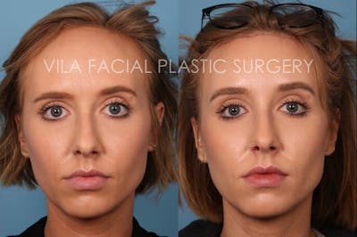 Forehead Reduction Before & After Gallery - Patient 20061801 - Image 1