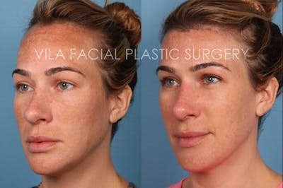 Forehead Reduction Before & After Gallery - Patient 20061800 - Image 2