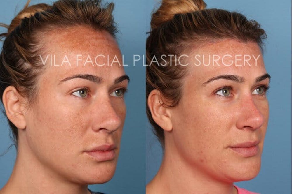 Forehead Reduction Before & After Gallery - Patient 20061800 - Image 3