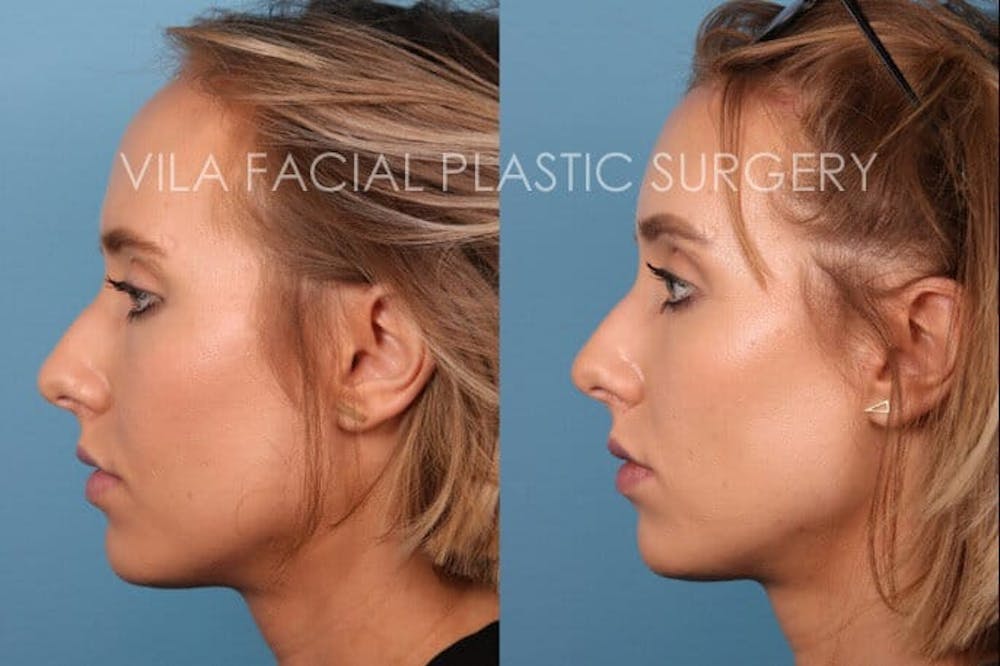 Forehead Reduction Before & After Gallery - Patient 20061801 - Image 3