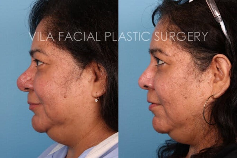 Rhinophyma Before & After Gallery - Patient 20061806 - Image 2