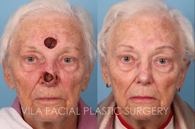 Facial Reconstruction Before & After Gallery - Patient 20081174 - Image 1