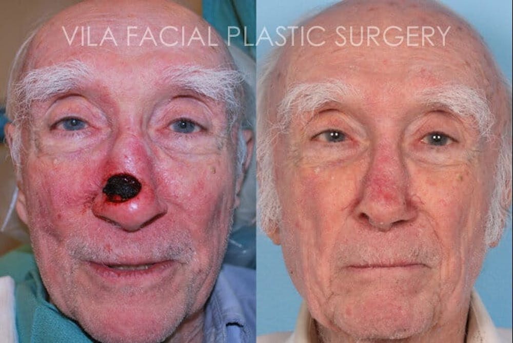 Facial Reconstruction Before & After Gallery - Patient 20081175 - Image 1