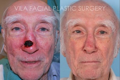 Facial Reconstruction Before & After Gallery - Patient 20081175 - Image 1