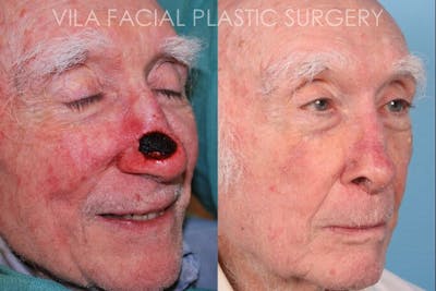 Facial Reconstruction Before & After Gallery - Patient 20081175 - Image 2