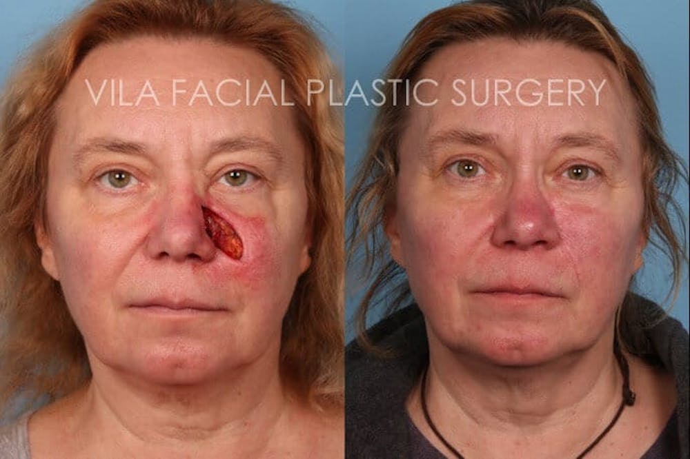 Facial Reconstruction Before & After Gallery - Patient 20081176 - Image 1