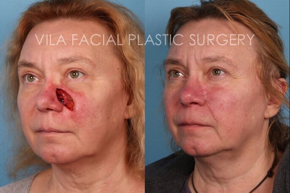 Facial Reconstruction Before & After Gallery - Patient 20081176 - Image 2