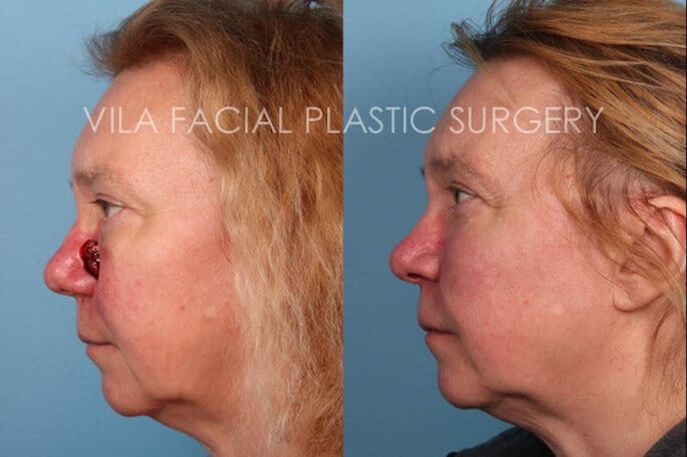 Facial Reconstruction Before & After Gallery - Patient 20081176 - Image 3