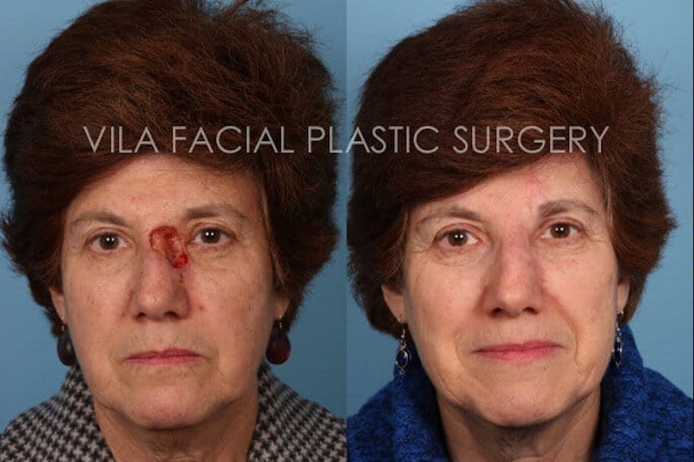 Facial Reconstruction Before & After Gallery - Patient 20081177 - Image 1