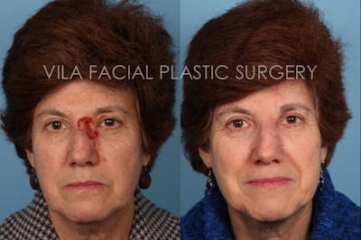 Facial Reconstruction Before & After Gallery - Patient 20081177 - Image 1