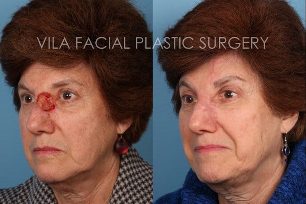 Facial Reconstruction Before & After Gallery - Patient 20081177 - Image 2