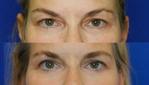 Upper Eyelid Surgery in Portland Before & After Photos