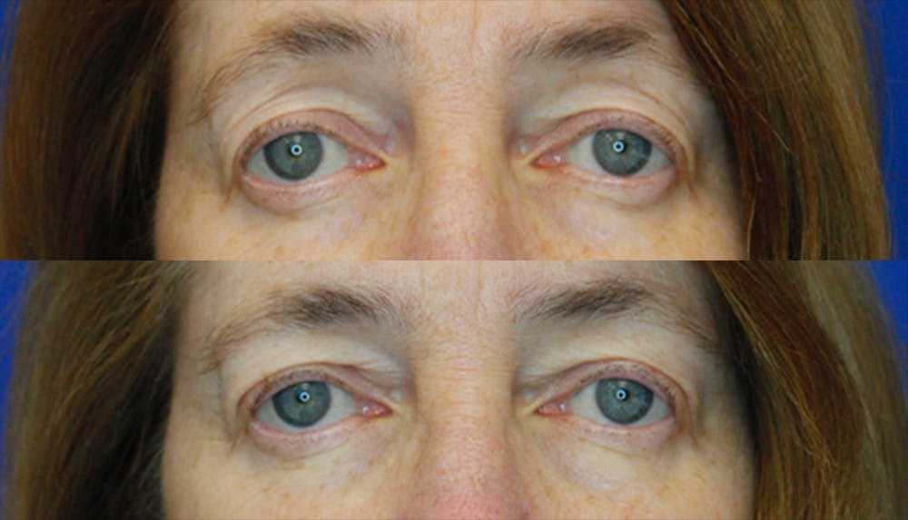 Upper Blepharoplasty Before & After Gallery - Patient 51666393 - Image 1