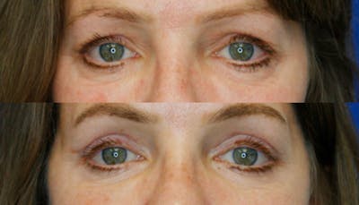 Upper Blepharoplasty Before & After Gallery - Patient 51666394 - Image 1
