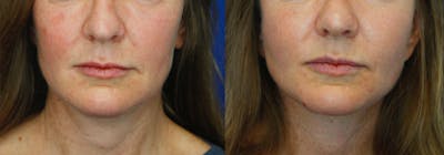 Facelift Before & After Gallery - Patient 51666452 - Image 1