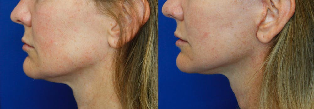 Facelift Before & After Gallery - Patient 51666452 - Image 3