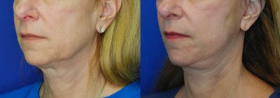 Facelift Before & After Gallery - Patient 51666453 - Image 2