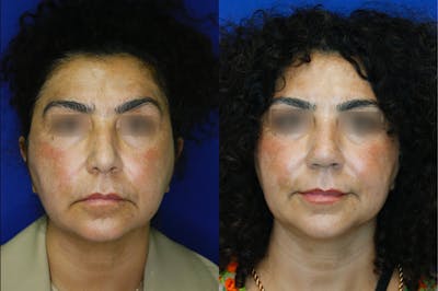 Rhinoplasty Before & After Gallery - Patient 52294369 - Image 2