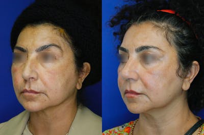 Rhinoplasty Before & After Gallery - Patient 52294369 - Image 2
