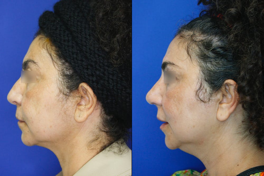 Rhinoplasty Before & After Gallery - Patient 52294369 - Image 3