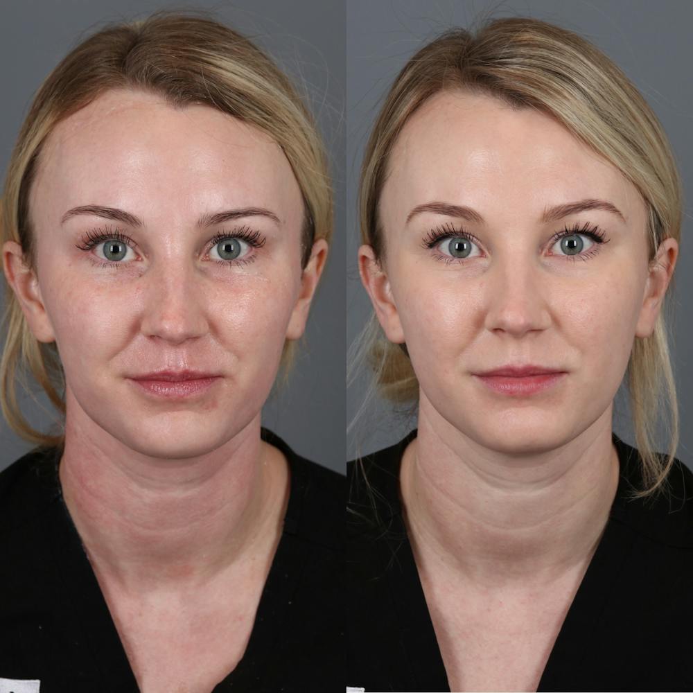 Morpheus8 RF Microneedling Before & After Gallery - Patient 123046192 - Image 1