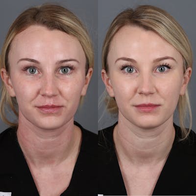 Morpheus8 RF Microneedling Before & After Gallery - Patient 123046192 - Image 1