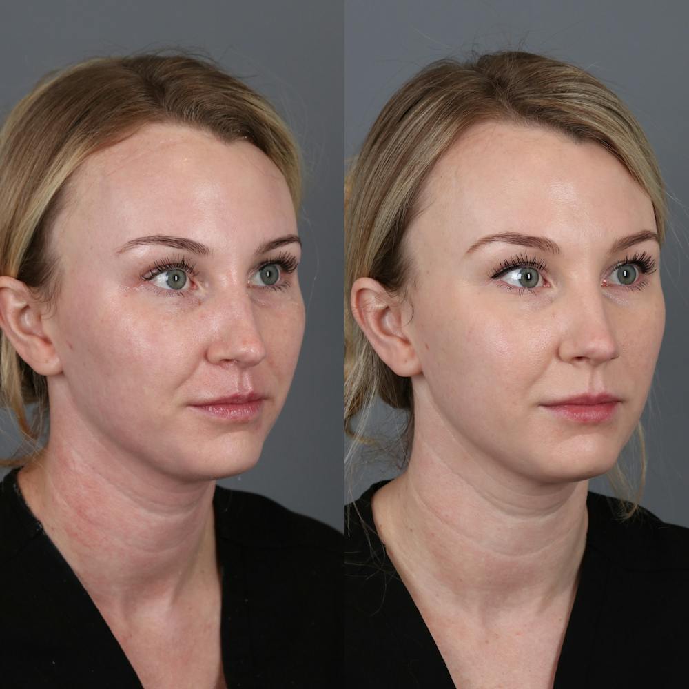 Morpheus8 RF Microneedling Before & After Gallery - Patient 123046192 - Image 2