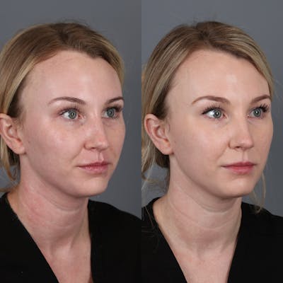 Morpheus8 RF Microneedling Before & After Gallery - Patient 123046192 - Image 2