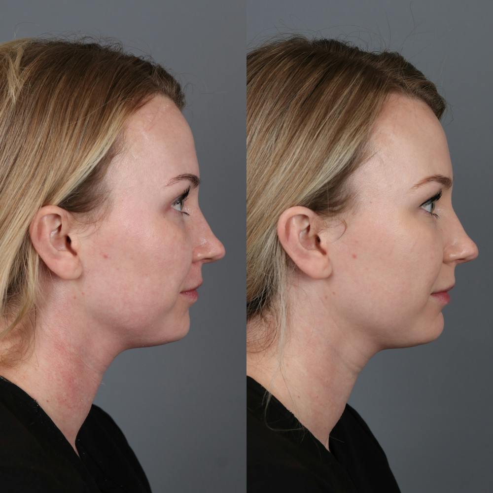Morpheus8 RF Microneedling Before & After Gallery - Patient 123046192 - Image 3