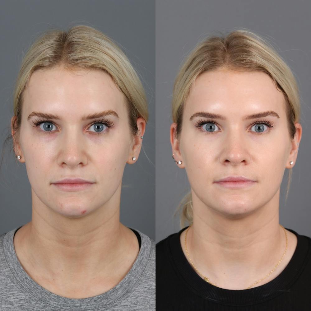 Morpheus8 RF Microneedling Before & After Gallery - Patient 123046196 - Image 1