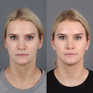 Morpheus8 Before and After