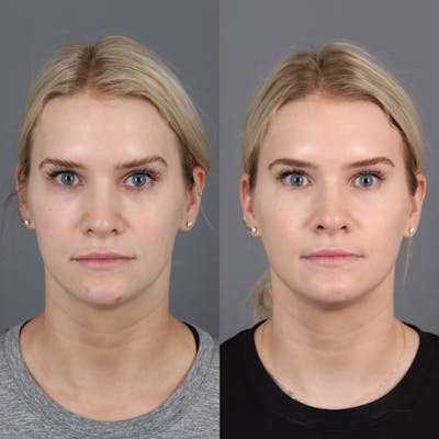 Morpheus8 RF Microneedling Before & After Gallery - Patient 123046196 - Image 1