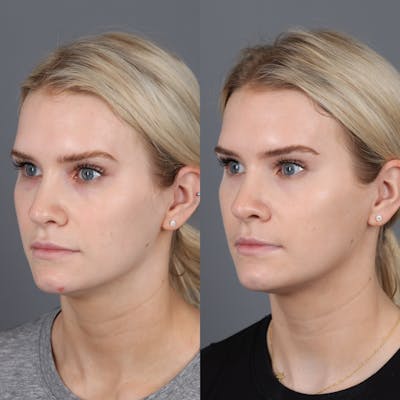 Morpheus8 RF Microneedling Before & After Gallery - Patient 123046196 - Image 2