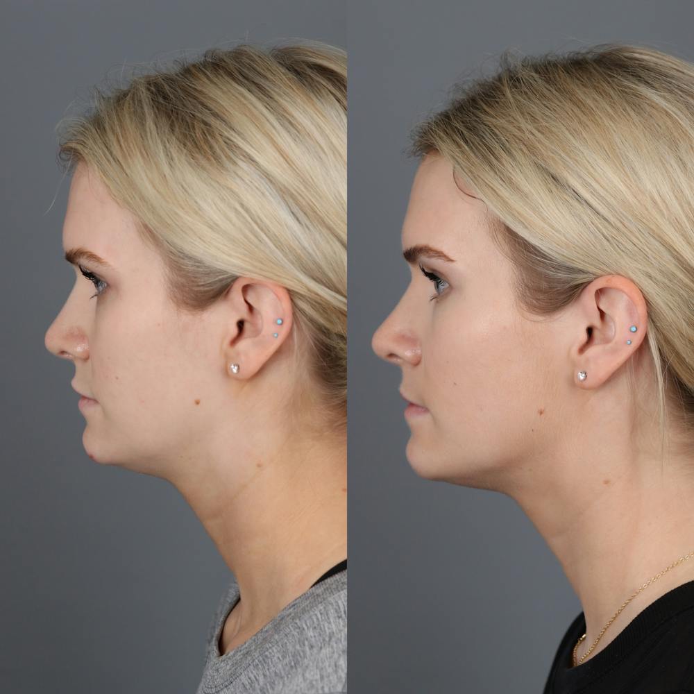 Morpheus8 RF Microneedling Before & After Gallery - Patient 123046196 - Image 3