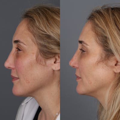 Liquid Rhinoplasty Before & After Gallery - Patient 123046198 - Image 1