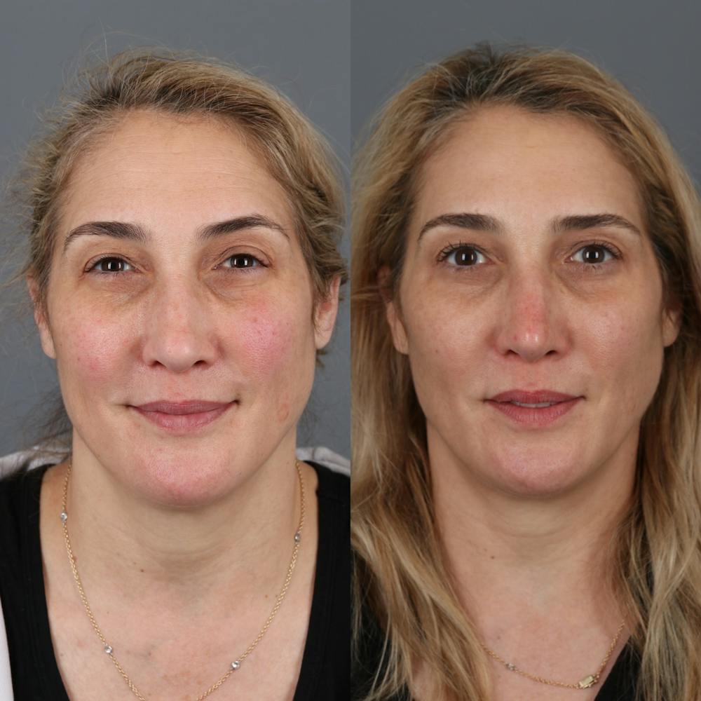 Liquid Rhinoplasty Before & After Gallery - Patient 123046198 - Image 3