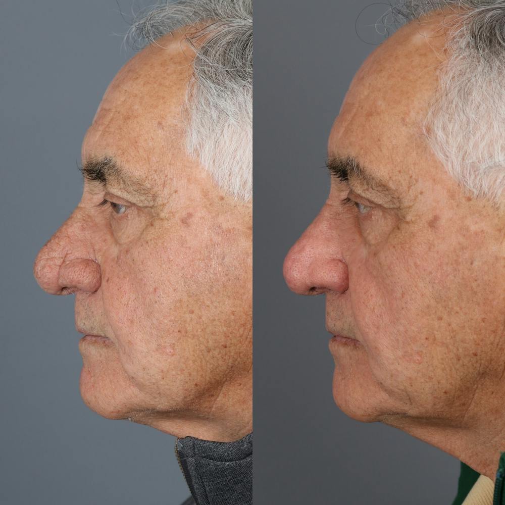 Rhinophyma Before & After Gallery - Patient 123046216 - Image 1