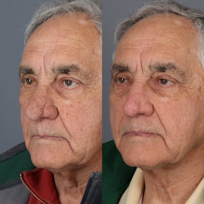 Rhinophyma Before & After Gallery - Patient 123046216 - Image 2