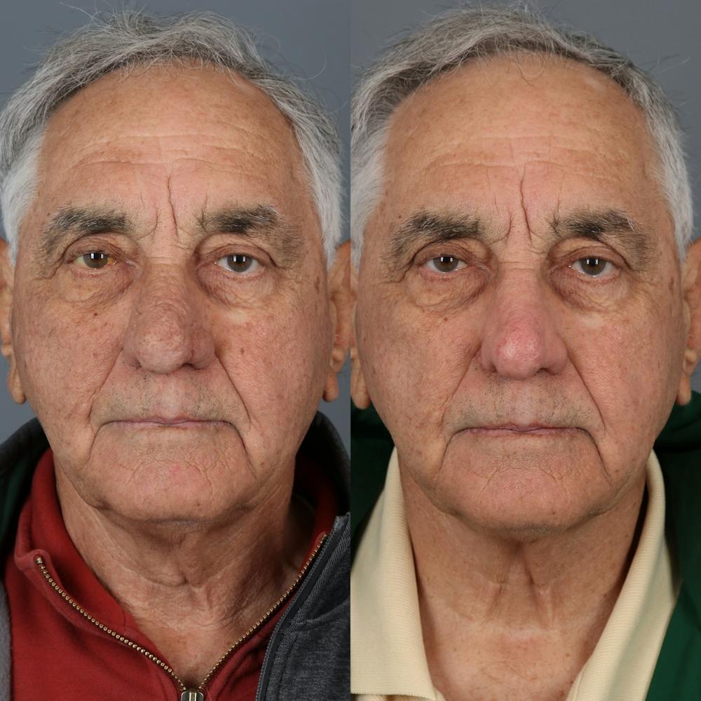 Rhinophyma Before & After Gallery - Patient 123046216 - Image 3