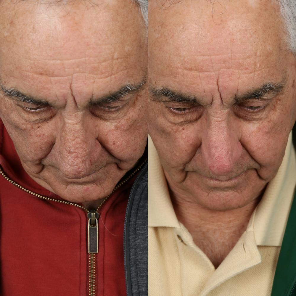 Rhinophyma Before & After Gallery - Patient 123046216 - Image 4